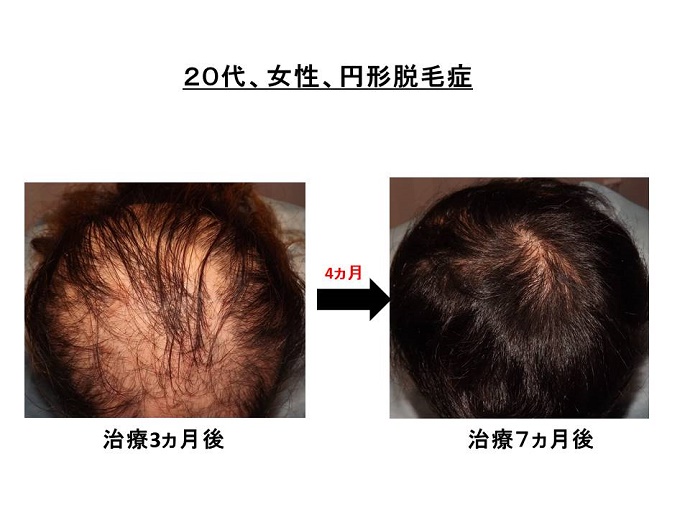 円形脱毛症　病院""